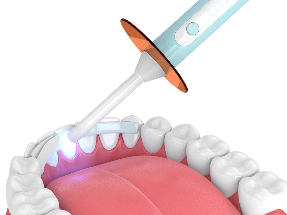 Graphic depicting a dental bonding procedure