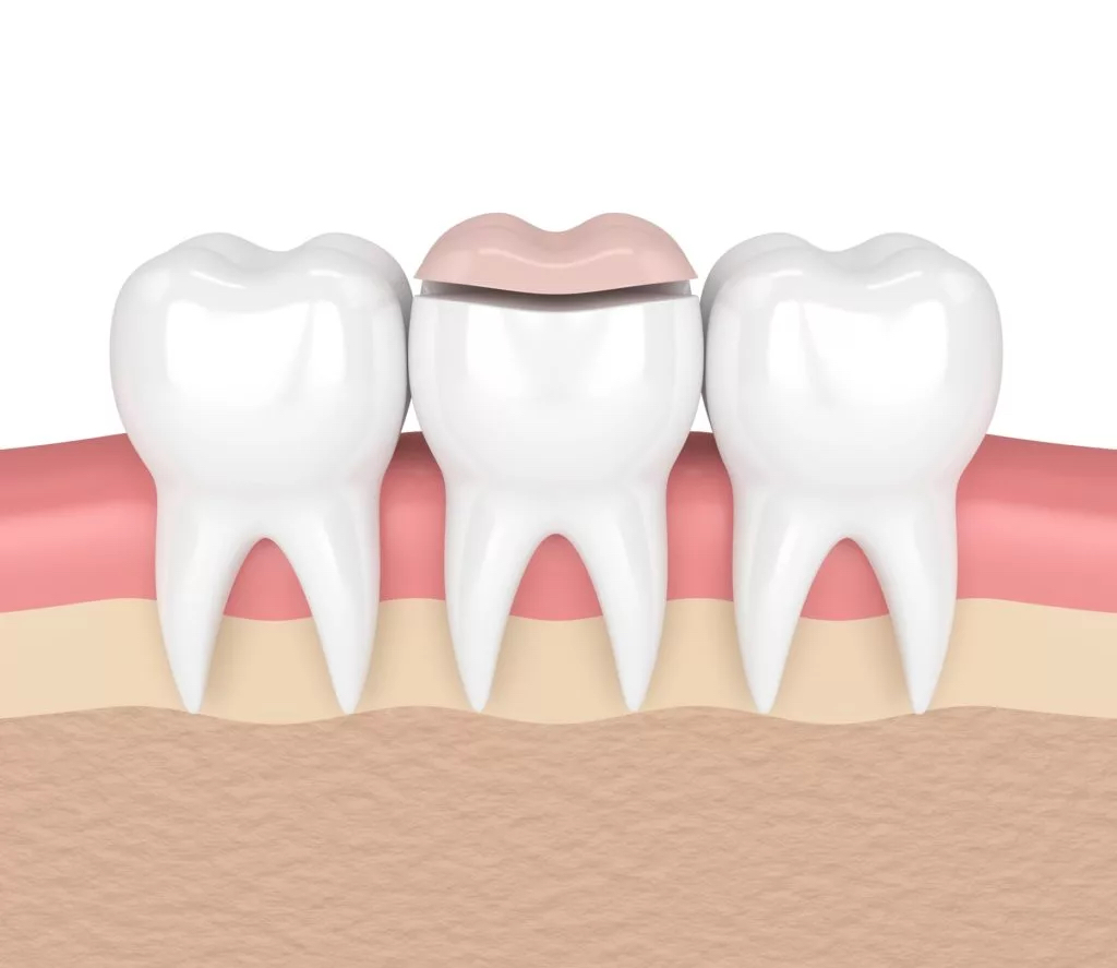 Graphic depicting a dental inlay and onlay procedure