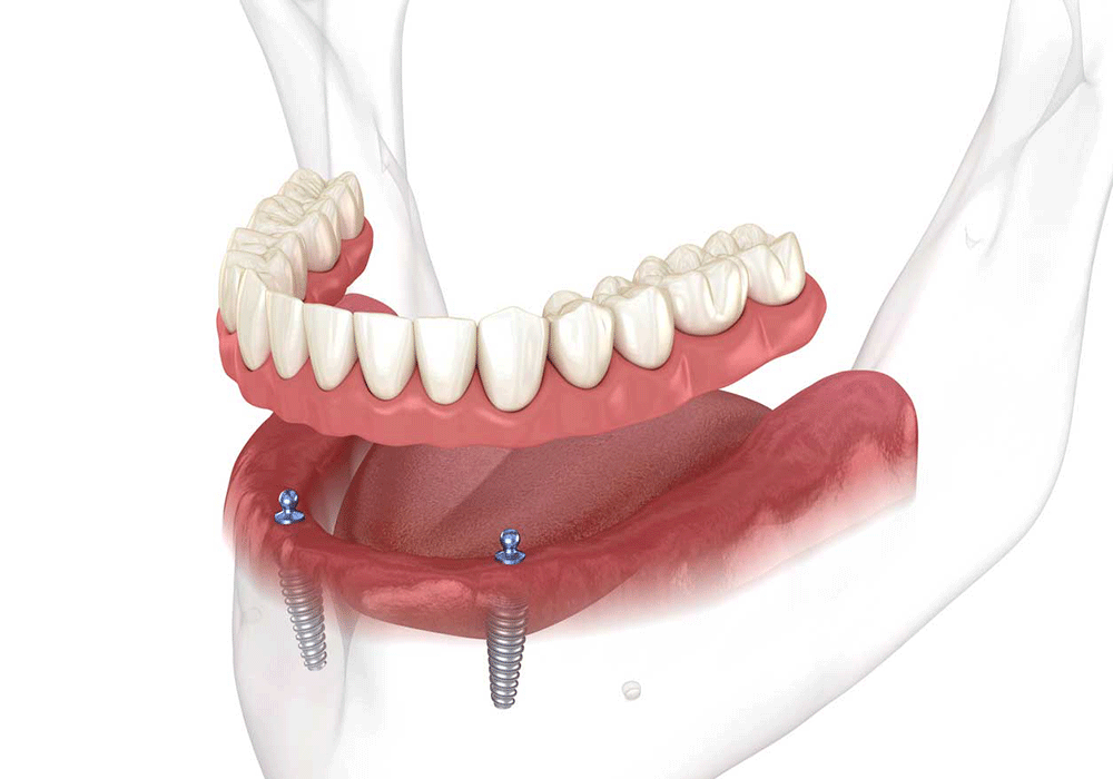 Graphic depicting how snap-on dentures are placed into the mouth