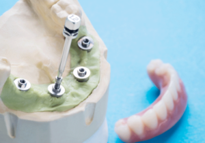 Photo of dental implant screws on a practice jaw bone and a set on bottom row dentures