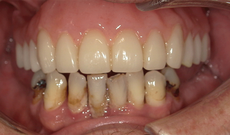 Photo of a patient's teeth after undergoing full-mouth dental implant surgery.
