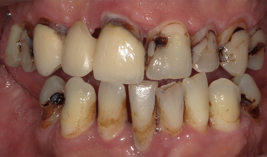 Photo of a patient's teeth before undergoing full-mouth dental implant surgery.