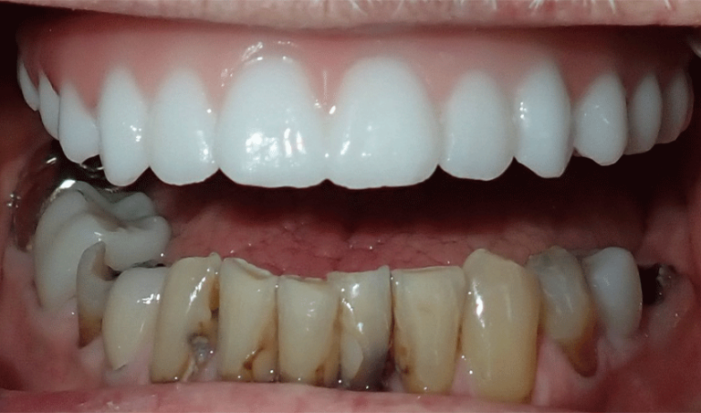 Photo of a patient's teeth after undergoing full-mouth dental implant surgery.