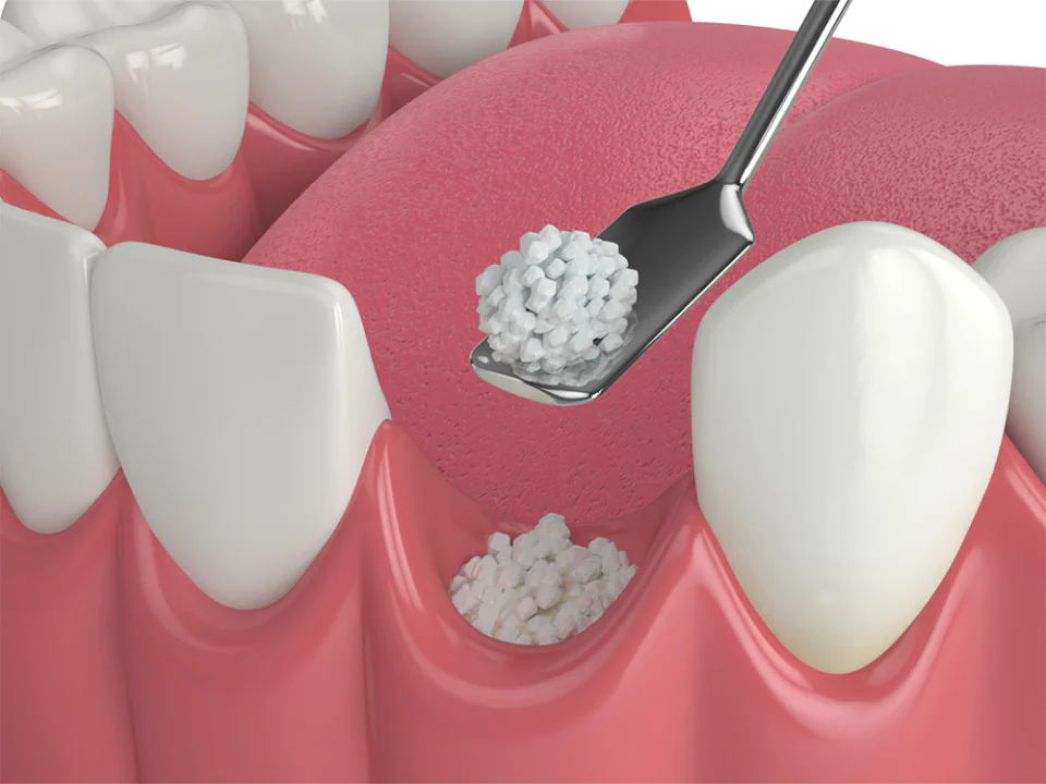 Dental bone grafting services at Drew Family Dentistry in Bend, OR