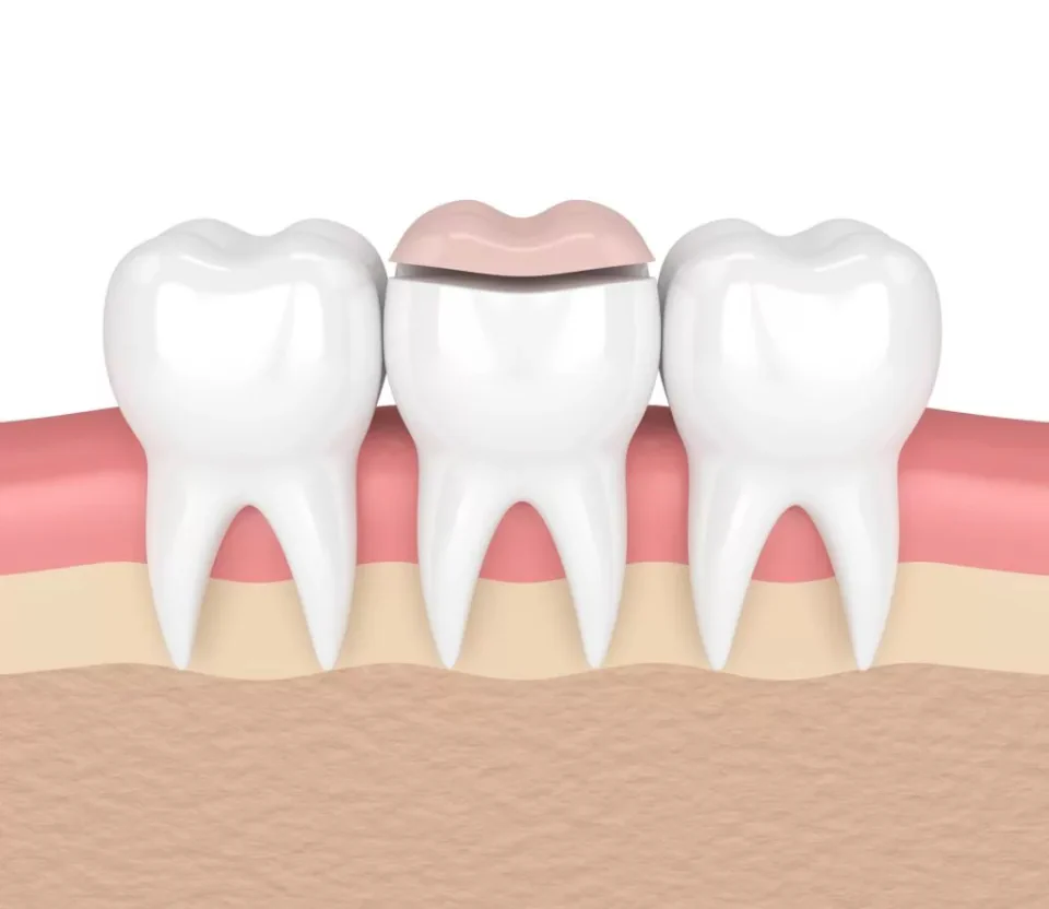 Dental inlays and onlays available at Drew Family Dentistry in Bend, OR