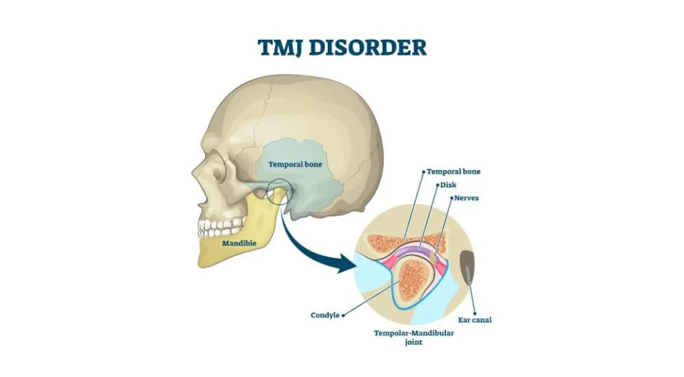 TMJ disorder treatments available at Drew Family Dentistry in Bend, OR