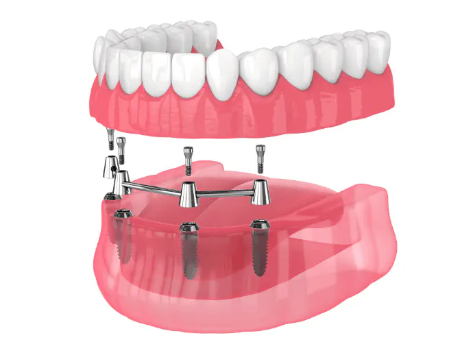 Full mouth dental implants available from Drew Family Dentistry in Bend, OR