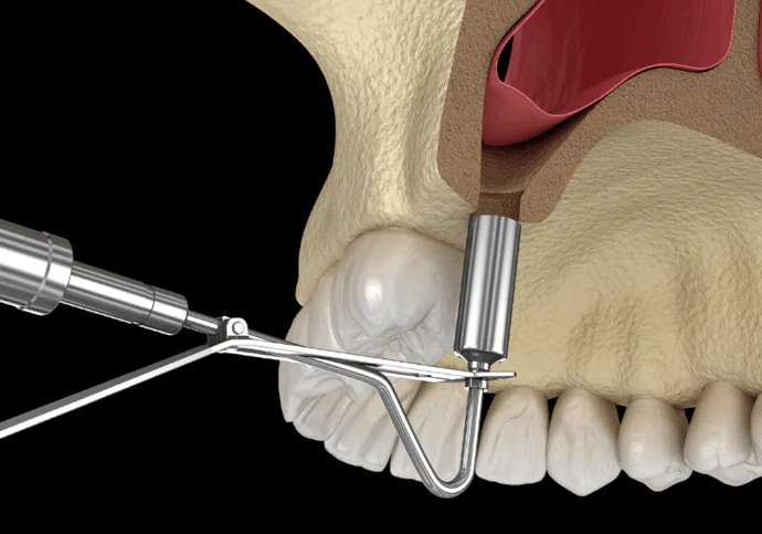 Sinus lift procedures available at Drew Family Dentistry in Bend, OR