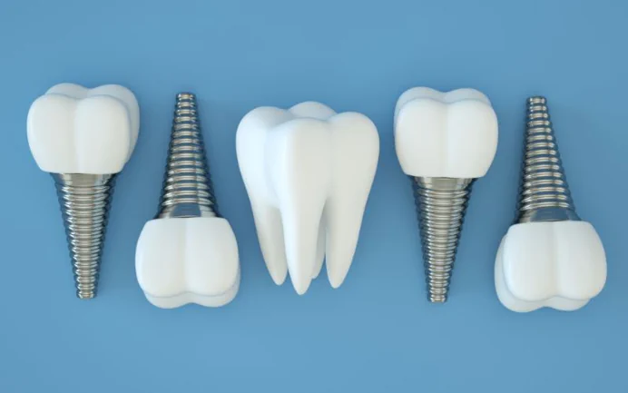 Full-Mouth Dental Implants at Drew Family Dentistry in Bend, OR
